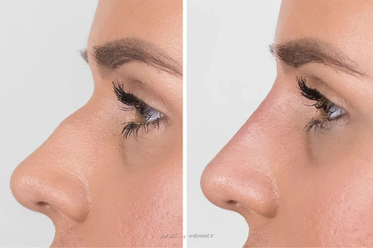 مزایا و معایب فیلر بینی